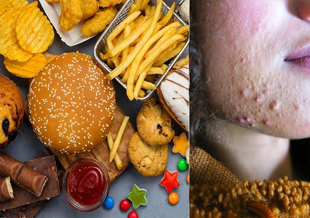 چه مواد غذایی باعث جوش صورت میشود